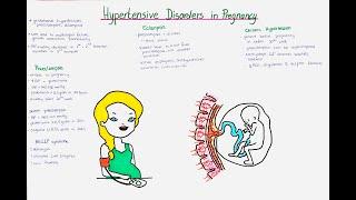 Hypertensive Disorders in Pregnancy - Preeclampsia, Eclampsia, Gestational Hypertension