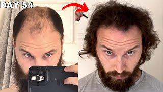 BALDING HAIR GROWTH For 1.5 Years - Reviewed