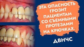 Эта опасность грозит пациентам со съёмными протезами на крючках. ДВНЧС.