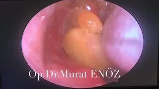 Nasal Polyps Filling Both Nasal Cavities