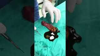 Yeşil Zeytin mi, Safra Taşı mı? #shorts