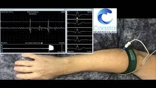 Needle EMG demonstration