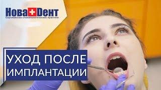  Важные рекомендации после имплантации зубов. Рекомендации после имплантации. НоваДент. 12+