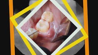 Drainage and Extraction of Lower Molar Abscess