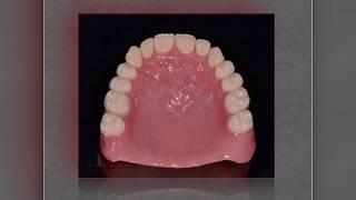 Протезирование при полном отсутствии зубов | СЦ «Дентика»