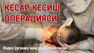 Кесар кесиш операцияси | Cesarean section operation