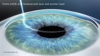 LASIK Laser Eye Surgery explained