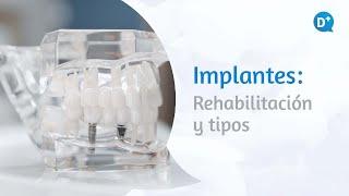 Tipos de implantes y rehabilitación | Dr. Fernando Loscos Morato - Especialista en Estomatología