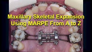 Maxillary Skeletal Expansion using MARPE from A to Z (Updated)