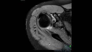 ADHESIVE CAPSULITIS (FROZEN SHOULDER) ON MRI