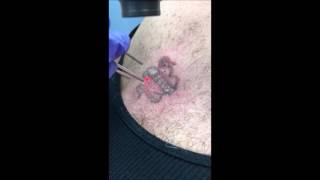 Laser Tattoo Removal Colored Ink, Skin Deep, Burke, Alexandria, Arlington, Springfield,& Fairfax VA