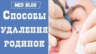 Как удалить родинку? | Хирургические способы удаления невусов на лице и теле | Плюсы и минусы