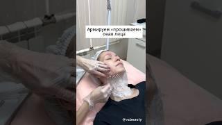 Армирование кожи лица мезонитями. Так же иногда можно встретить термин «прошивание» лица.