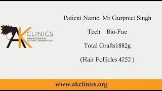 Patient review hair transplant - AK Clinics