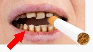 If You Like Your Teeth... STOP Smoking/Vaping