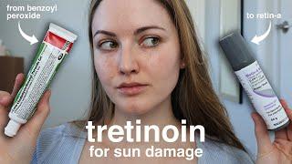 Does Tretinoin (Retin-A) Help With Sun Spots, Damage & Melasma? My 4-Month Results