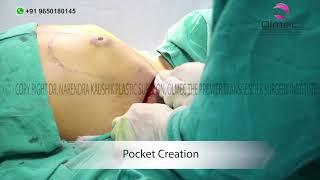 Breast augmentation | Highly cohesive nanotextured implant | by Dr. Kaushik | Olmec
