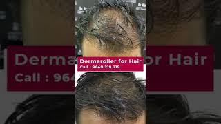 Derma Roller For Hair Treatment Has The Answer To Everything | viral #shorts  #dermaroller