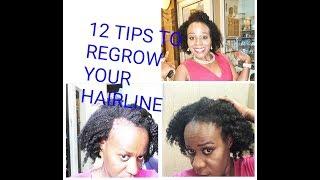 HOW TO REGROW YOUR HAIRLINE OR EDGES/ BALD SPOTS REALISTICALLY | POSTPARTUM SHEDDING