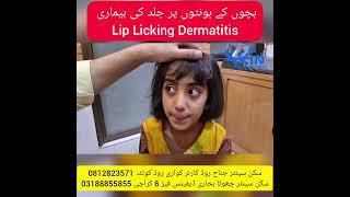 Lip licking dermatitis | Dermatologist | Dr Syed Bilal Shams @skincenter.pakistan