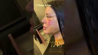 Complete Facial Transformation: Scarless Facelift, Necklift & Rhinoplasty by DR Tas