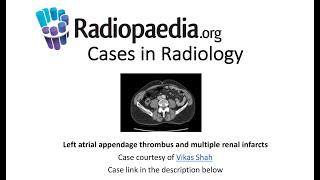 Left atrial appendage thrombus and multiple renal infarcts (Radiopaedia.org) Cases in Radiology