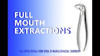 REMOVAL of ALL TEETH; the COMPLETE SURGERY! FULL MOUTH EXTRACTION CASE