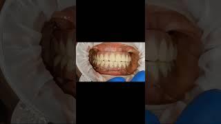 3 d patient resin full arch implant bridge fitting video for basal implants!!