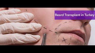 Beard Transplant Turkey |  Beard Transplant Cost Turkey