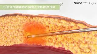 Laser Liposuction