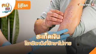 สะเก็ดเงินโรคผิวหนังที่รักษาไม่หาย | รู้สู้โรค