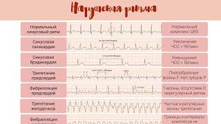 Норма и патология на ЭКГ: Нарушения Ритма
