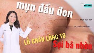 Cách trị mụn đầu đen ở mũi - sợi bã nhờn- lỗ chân lông to tại nhà - Bác sĩ Nguyên