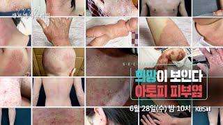 희망이 보인다 아토피피부염  [6월28일 방송 예고]