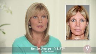 Y LIFT ® 2013 - Renée | Instant, Non Surgical Facelift