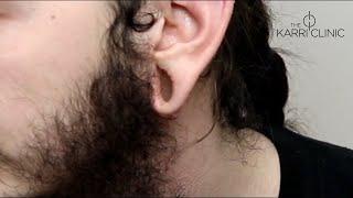 Earlobe tunnel repair | Before & after photos | The Karri Clinic | Mr Vasu Karri