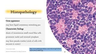 Ewing's Sarcoma