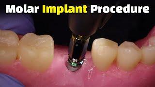 Step by Step Dental Implant Procedure - Back Molar