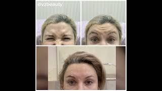 Результат инъекций Миотокс, через 2 недели #beauty #миотокс