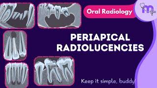 Periapical radiolucencies - Differential diagnosis , Radiographic features | Oral Radiology