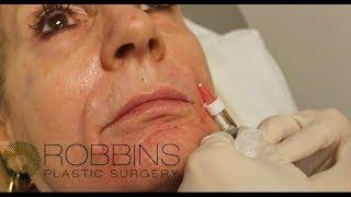 RESTYLANE FILLER- Top Rated Nashville Plastic Surgeon - Robbins Plastic Surgery