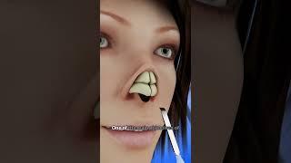 Transform Your Nose with Rhinoplasty #shorts - Creativelearning3d