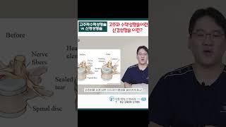 고주파수핵성형술vs신경성형술