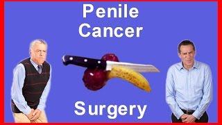 Ca Penile - How to do Penectomy for Penile Cancer and Lymphnode Dissection Surgery by Dr Majid Ahmed