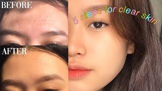 MY 5 BASIC STEPS FOR CLEAR SKIN  (Philippines)