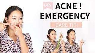 [BTS] KOREAN Acne care tip for emergency acne situation :Dr. KRISMAS