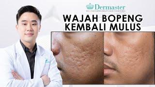 WAJAH BOPENG KEMBALI MULUS! | Meet The #BeautyExpert : Episode 12