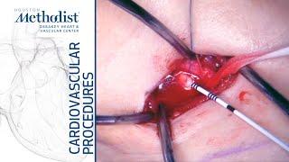 Transcarotid Artery Revascularization - TCAR (Alan B. Lumsden, MD)