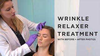 Wrinkle Relaxer Injection Video with Before and After