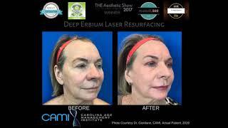 Deep Laser Resurfacing at your Charlotte / Huntersville NC Med Spa